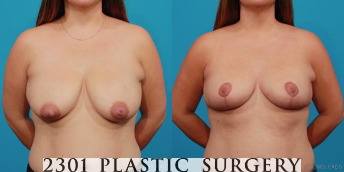 Before & After Breast Lift (Mastopexy) Case 352 View #1 View in Fort Worth, Plano, & Frisco, Texas