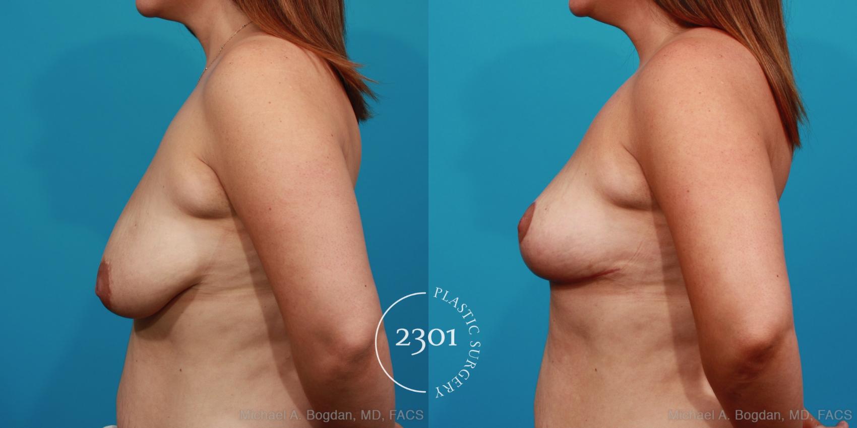 Before & After Breast Lift (Mastopexy) Case 352 View #2 View in Fort Worth, Plano, & Frisco, Texas
