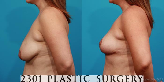 Before & After Breast Lift (Mastopexy) Case 352 View #2 View in Fort Worth, Plano, & Frisco, Texas