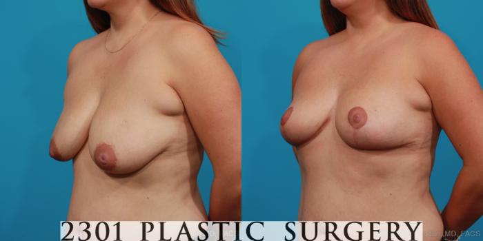 Before & After Breast Lift (Mastopexy) Case 352 View #3 View in Fort Worth, Plano, & Frisco, Texas