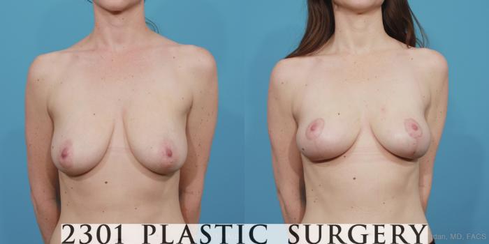 Before & After Breast Lift (Mastopexy) Case 384 View #1 View in Fort Worth, Plano, & Frisco, Texas