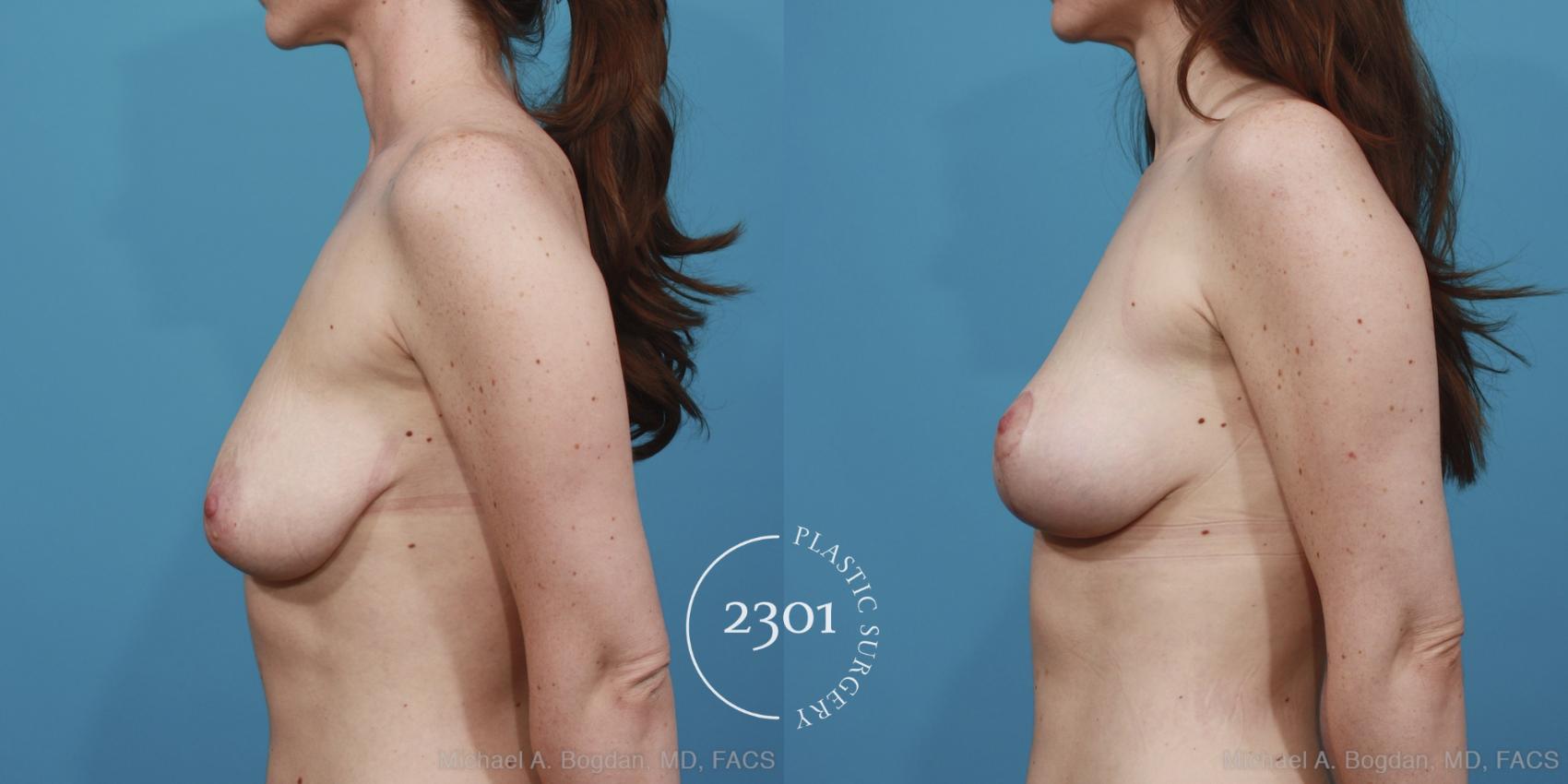 Before & After Breast Lift (Mastopexy) Case 384 View #2 View in Fort Worth, Plano, & Frisco, Texas