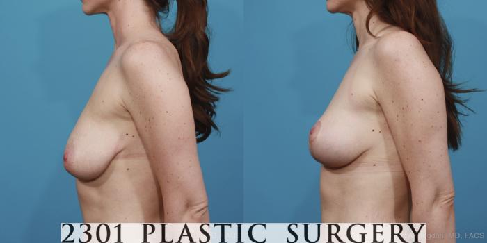 Before & After Breast Lift (Mastopexy) Case 384 View #2 View in Fort Worth, Plano, & Frisco, Texas