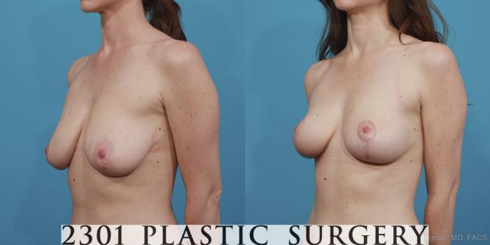 Before & After Breast Lift (Mastopexy) Case 384 View #3 View in Fort Worth, Plano, & Frisco, Texas