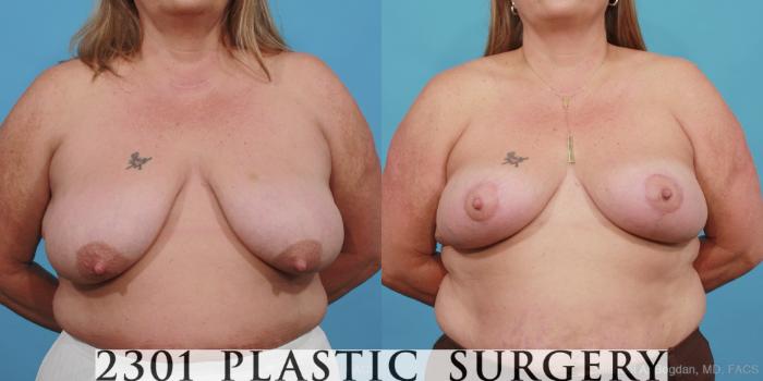 Before & After Breast Lift (Mastopexy) Case 445 View #1 View in Fort Worth, Plano, & Frisco, Texas
