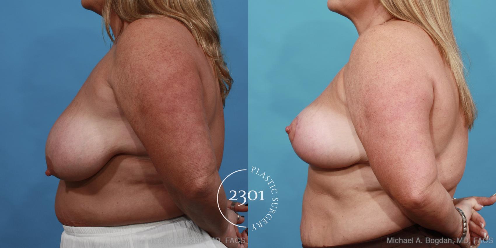 Before & After Breast Lift (Mastopexy) Case 445 View #2 View in Fort Worth, Plano, & Frisco, Texas