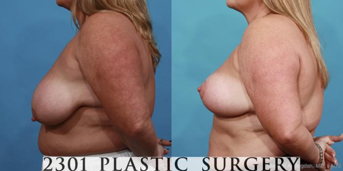 Before & After Breast Lift (Mastopexy) Case 445 View #2 View in Fort Worth, Plano, & Frisco, Texas