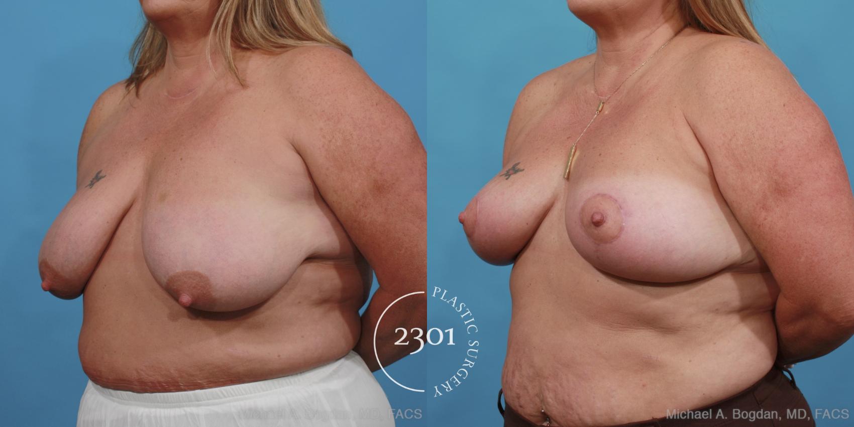 Before & After Breast Lift (Mastopexy) Case 445 View #3 View in Fort Worth, Plano, & Frisco, Texas