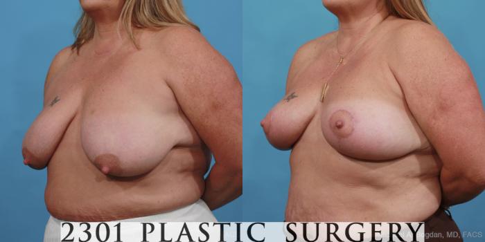 Before & After Breast Lift (Mastopexy) Case 445 View #3 View in Fort Worth, Plano, & Frisco, Texas