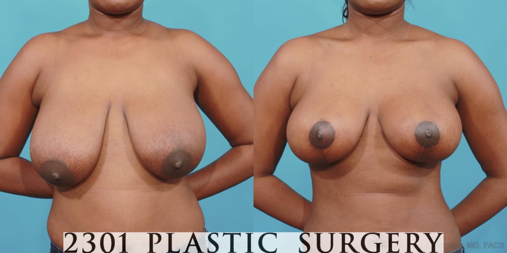 Before & After Breast Lift (Mastopexy) Case 525 View #1 View in Fort Worth & Frisco, Texas