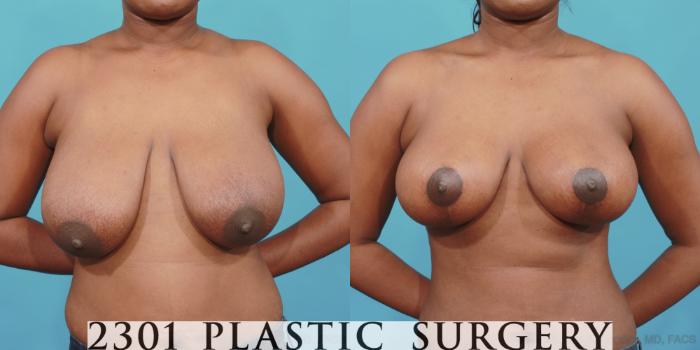 Before & After Breast Lift (Mastopexy) Case 525 View #1 View in Fort Worth, Plano, & Frisco, Texas