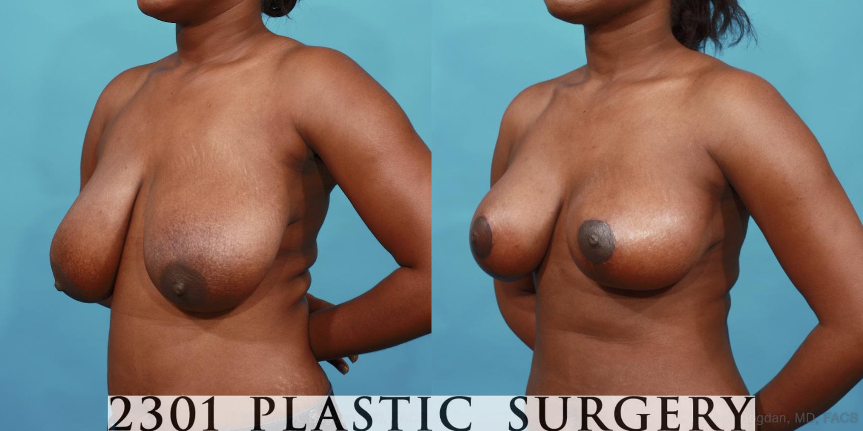 Before & After Breast Lift (Mastopexy) Case 525 View #2 View in Fort Worth & Frisco, Texas