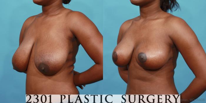 Before & After Breast Lift (Mastopexy) Case 525 View #2 View in Fort Worth, Plano, & Frisco, Texas