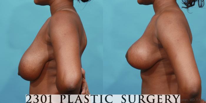Before & After Breast Lift (Mastopexy) Case 525 View #3 View in Fort Worth, Plano, & Frisco, Texas