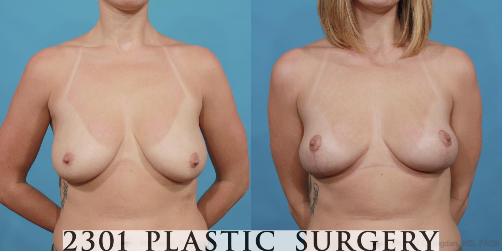 Before & After Breast Lift (Mastopexy) Case 529 View #1 View in Fort Worth, Plano, & Frisco, Texas