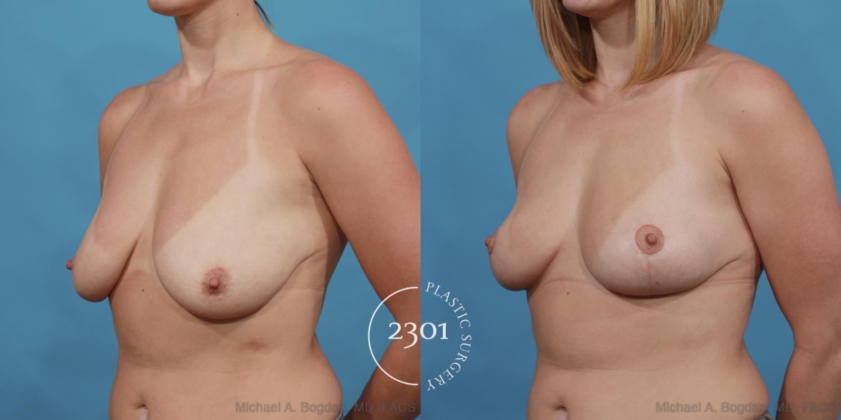 Before & After Breast Lift (Mastopexy) Case 529 View #2 View in Fort Worth, Plano, & Frisco, Texas