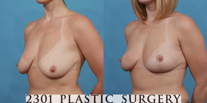 Before & After Breast Lift (Mastopexy) Case 529 View #2 View in Fort Worth, Plano, & Frisco, Texas