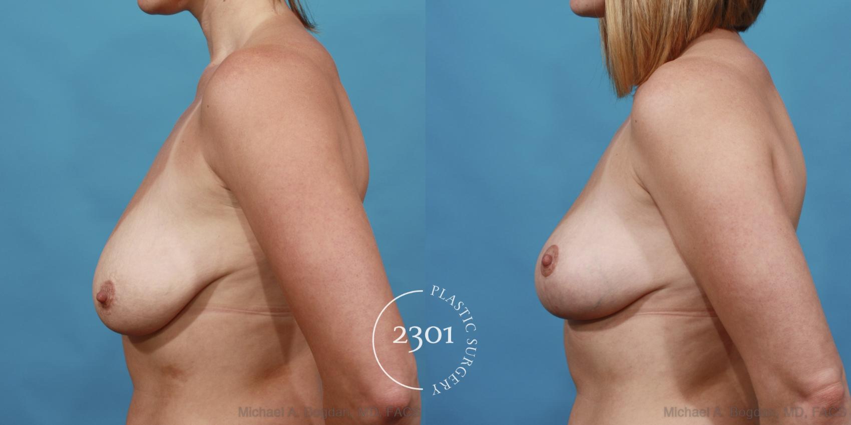 Before & After Breast Lift (Mastopexy) Case 529 View #3 View in Fort Worth, Plano, & Frisco, Texas