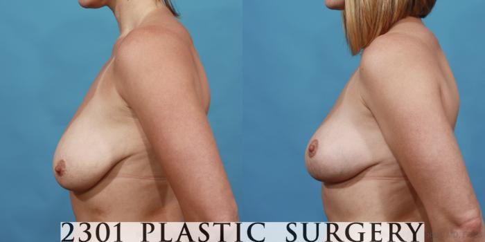 Before & After Breast Lift (Mastopexy) Case 529 View #3 View in Fort Worth, Plano, & Frisco, Texas