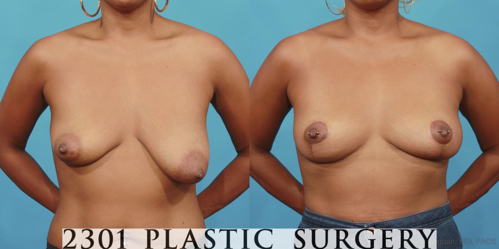 Before & After Breast Lift (Mastopexy) Case 563 View #1 View in Fort Worth & Frisco, Texas