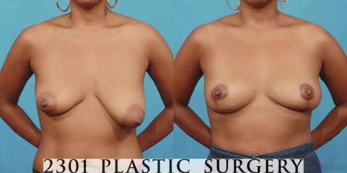 Before & After Breast Lift (Mastopexy) Case 563 View #1 View in Fort Worth, Plano, & Frisco, Texas