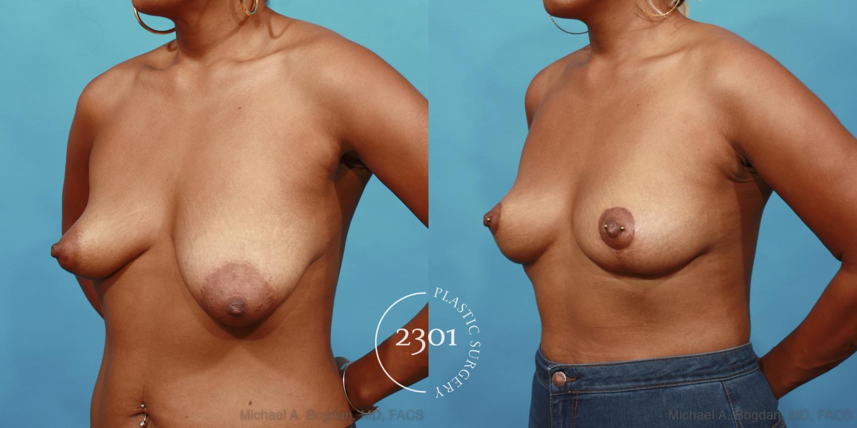 Before & After Breast Lift (Mastopexy) Case 563 View #2 View in Fort Worth, Plano, & Frisco, Texas