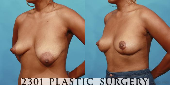 Before & After Breast Lift (Mastopexy) Case 563 View #2 View in Fort Worth, Plano, & Frisco, Texas