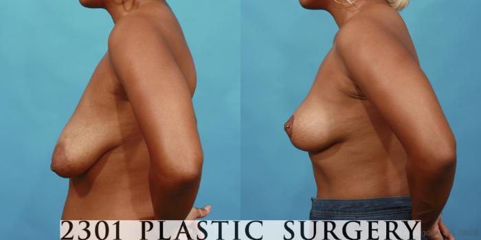 Before & After Breast Lift (Mastopexy) Case 563 View #3 View in Fort Worth, Plano, & Frisco, Texas