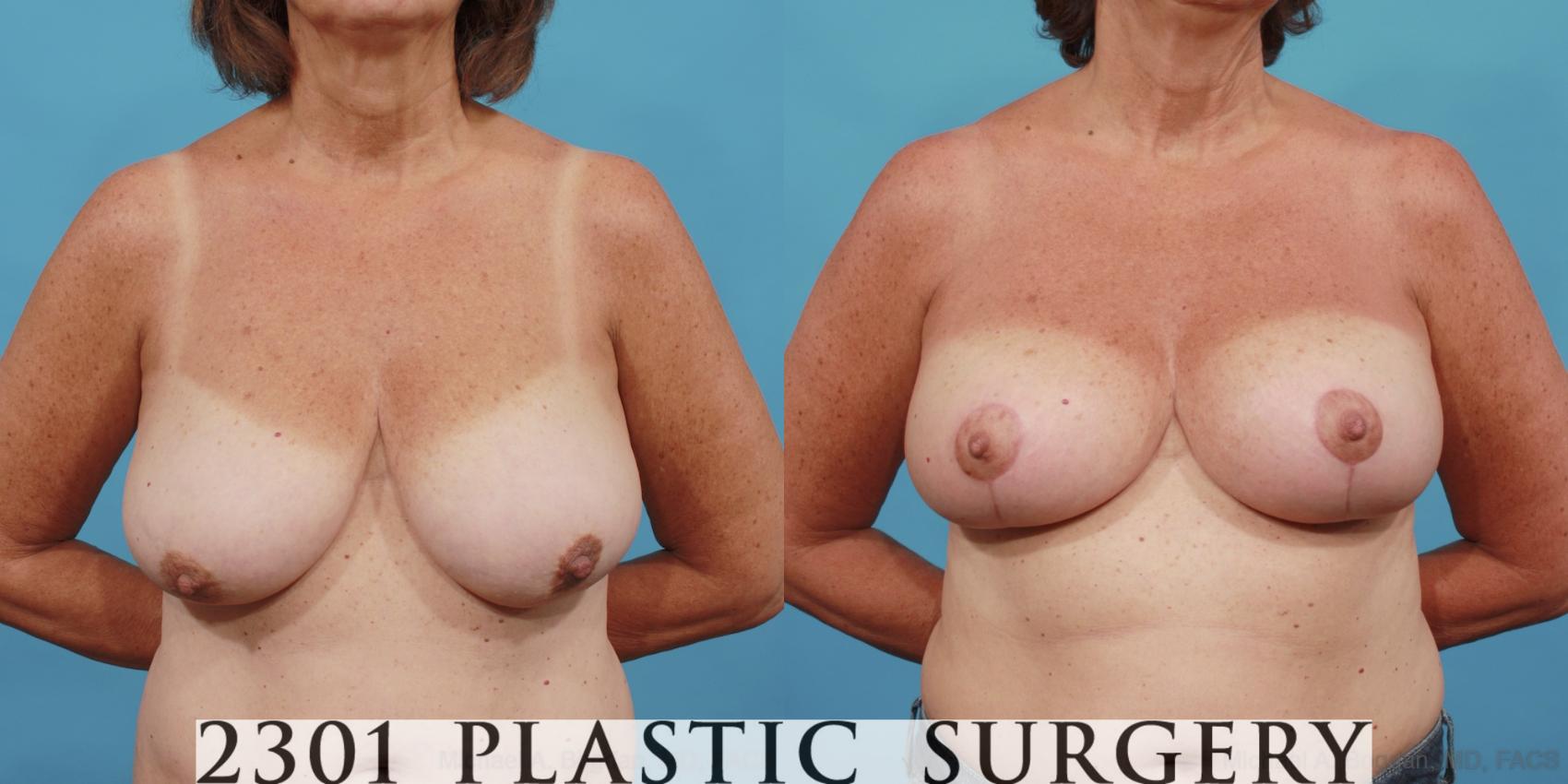 Before & After Breast Lift (Mastopexy) Case 564 View #1 View in Fort Worth, Plano, & Frisco, Texas