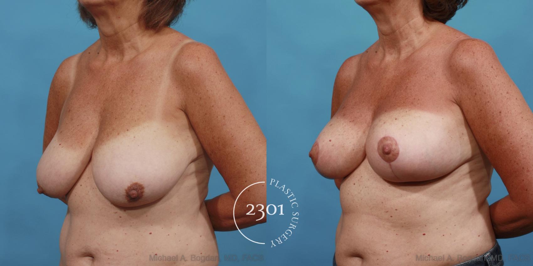 Before & After Breast Lift (Mastopexy) Case 564 View #2 View in Fort Worth, Plano, & Frisco, Texas