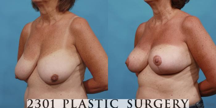 Before & After Breast Lift (Mastopexy) Case 564 View #2 View in Fort Worth, Plano, & Frisco, Texas