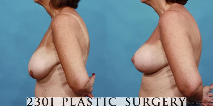 Before & After Breast Lift (Mastopexy) Case 564 View #3 View in Fort Worth, Plano, & Frisco, Texas
