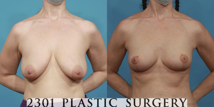 Before & After Breast Reduction Case 643 Front View in Fort Worth, Plano, & Frisco, Texas