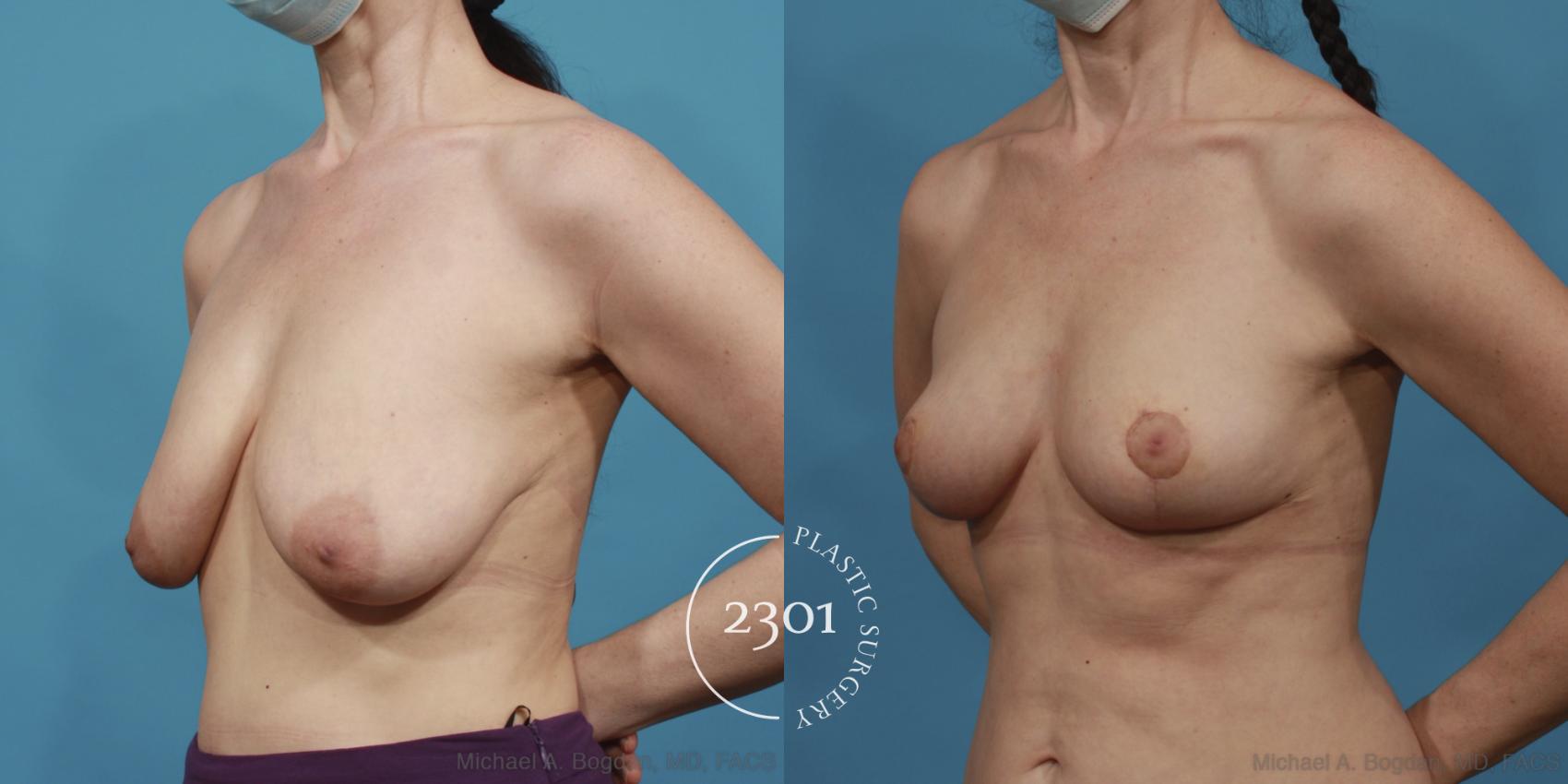 Before & After Breast Lift (Mastopexy) Case 643 Left Oblique View in Fort Worth, Plano, & Frisco, Texas