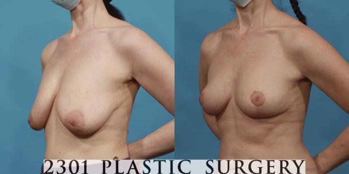 Before & After Breast Reduction Case 643 Left Oblique View in Fort Worth, Plano, & Frisco, Texas