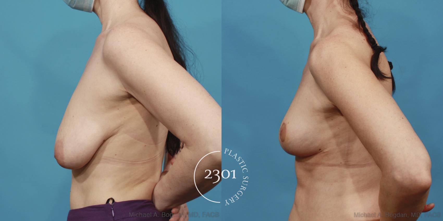 Before & After Breast Lift (Mastopexy) Case 643 Left Side View in Fort Worth, Plano, & Frisco, Texas