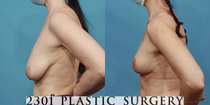 Before & After Breast Lift (Mastopexy) Case 643 Left Side View in Fort Worth, Plano, & Frisco, Texas
