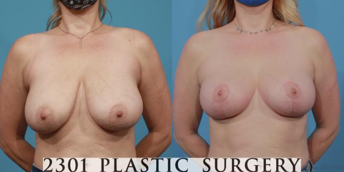 Before & After Breast Lift (Mastopexy) Case 644 Front View in Fort Worth, Plano, & Frisco, Texas