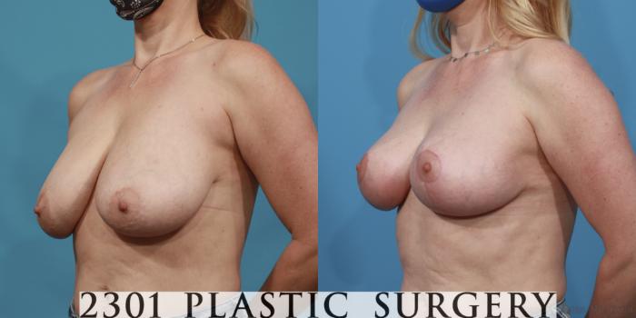 Before & After Breast Lift (Mastopexy) Case 644 Left Oblique View in Fort Worth, Plano, & Frisco, Texas