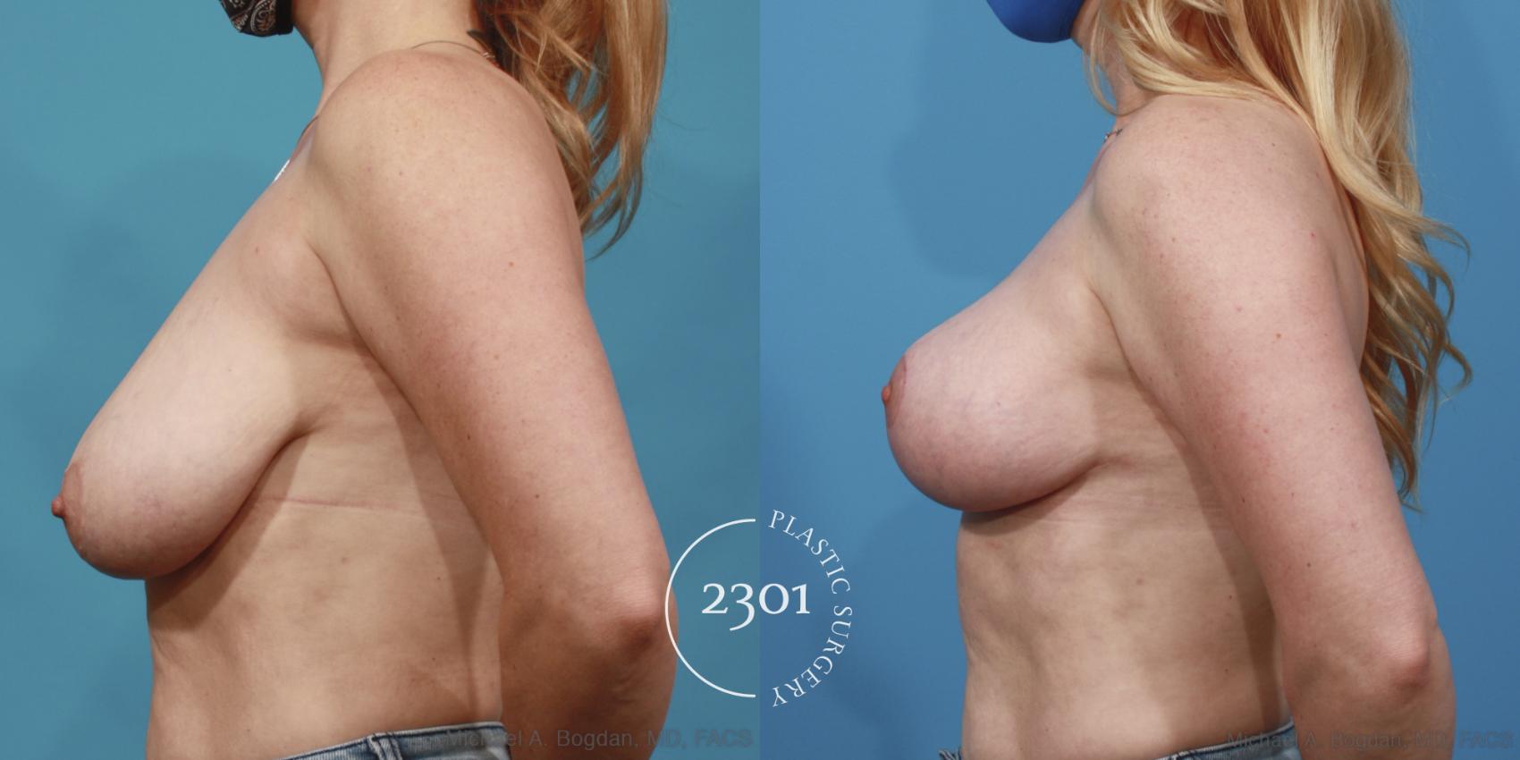 Before & After Breast Lift (Mastopexy) Case 644 Left Side View in Fort Worth, Plano, & Frisco, Texas