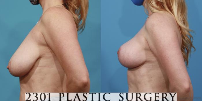 Before & After Breast Lift (Mastopexy) Case 644 Left Side View in Fort Worth, Plano, & Frisco, Texas