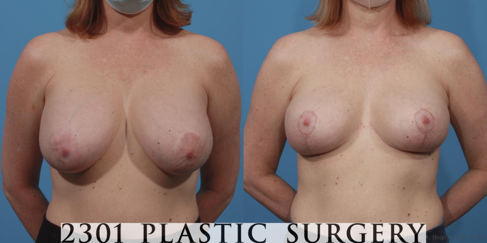 Before & After Breast Lift (Mastopexy) Case 645 Front View in Fort Worth & Frisco, Texas