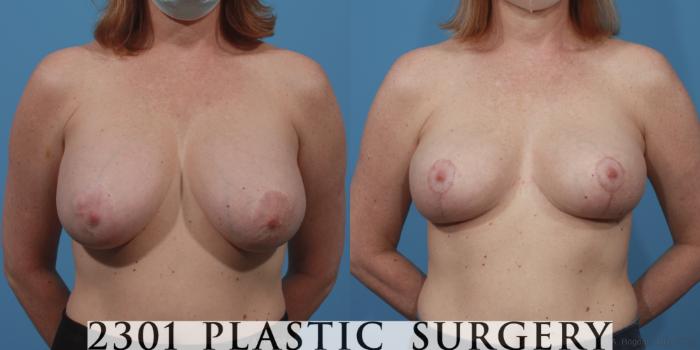 Before & After Breast Reduction Case 645 Front View in Fort Worth, Plano, & Frisco, Texas