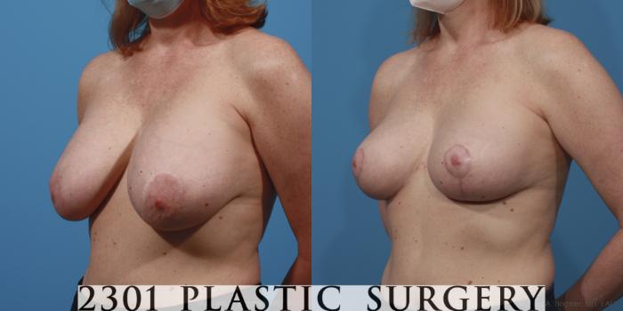 Before & After Breast Reduction Case 645 Left Oblique View in Fort Worth, Plano, & Frisco, Texas