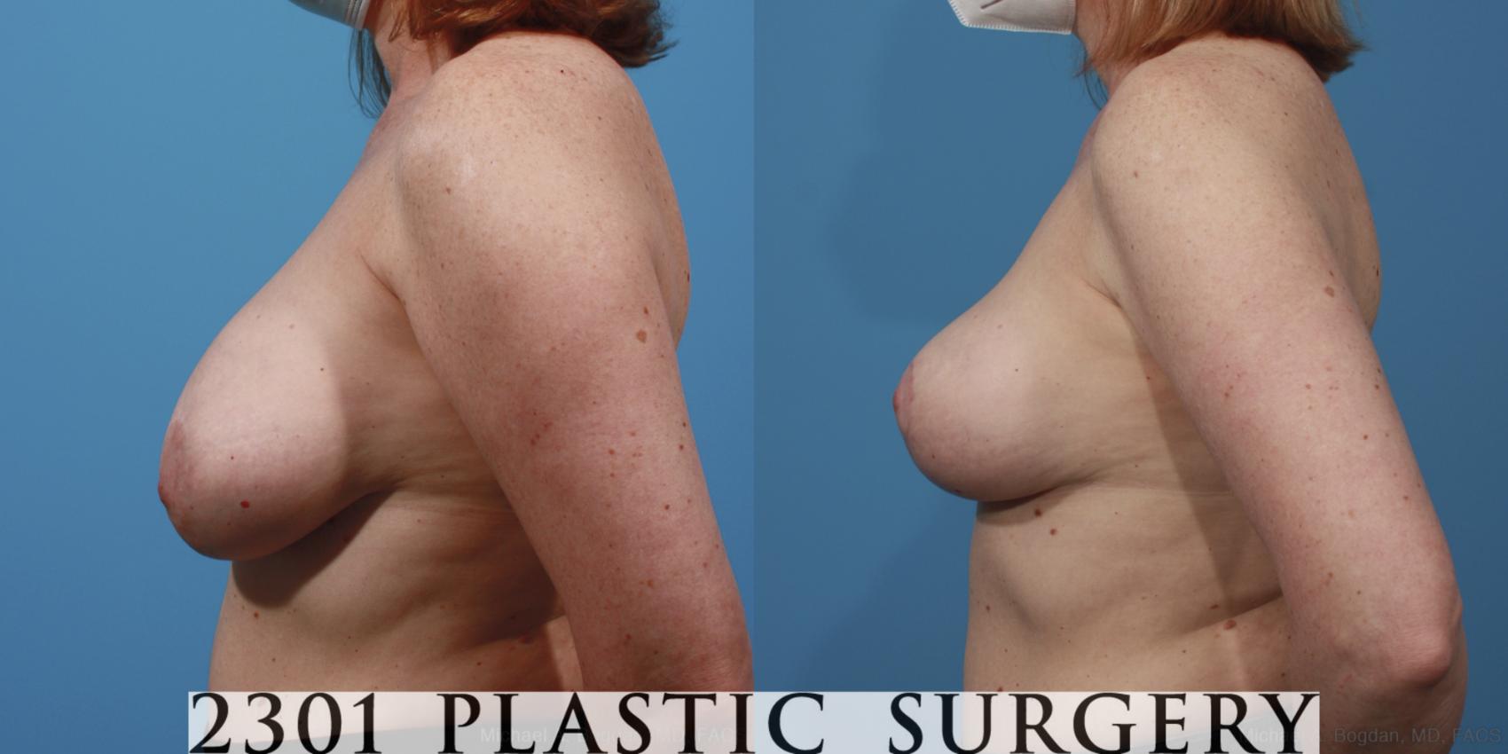 Before & After Breast Lift (Mastopexy) Case 645 Left Side View in Fort Worth & Frisco, Texas