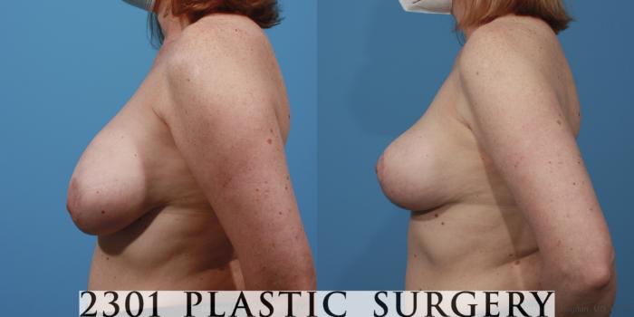 Before & After Breast Lift (Mastopexy) Case 645 Left Side View in Fort Worth, Plano, & Frisco, Texas