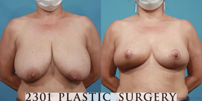 Before & After Breast Lift (Mastopexy) Case 646 Front View in Fort Worth, Plano, & Frisco, Texas