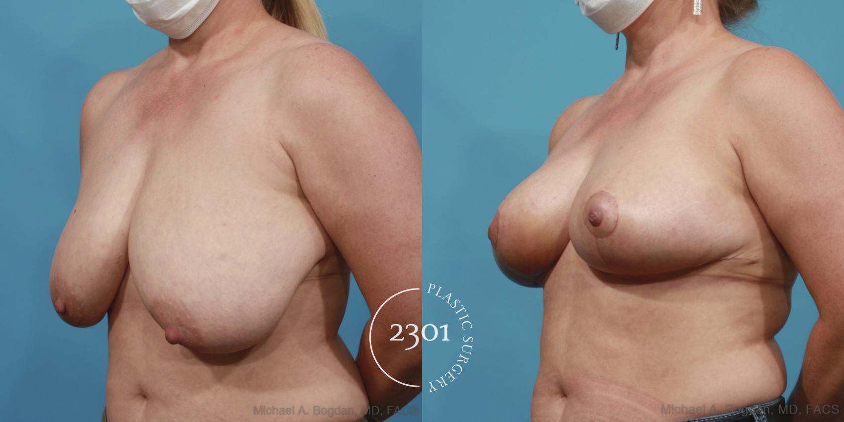 Before & After Breast Lift (Mastopexy) Case 646 Left Oblique View in Fort Worth, Plano, & Frisco, Texas