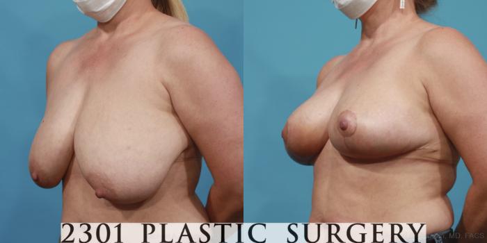 Before & After Breast Lift (Mastopexy) Case 646 Left Oblique View in Fort Worth, Plano, & Frisco, Texas