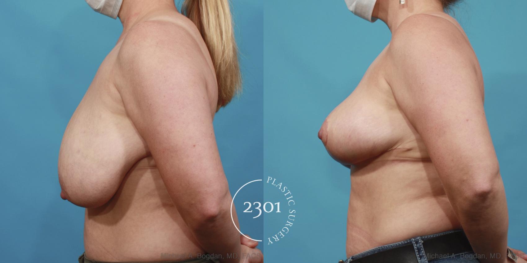 Before & After Breast Lift (Mastopexy) Case 646 Left Side View in Fort Worth, Plano, & Frisco, Texas